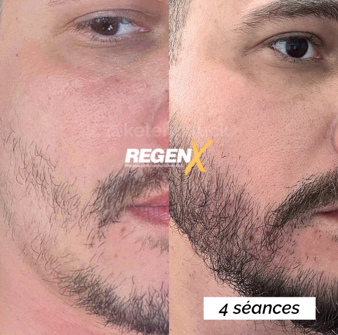 Regen X barbe, 4 séances