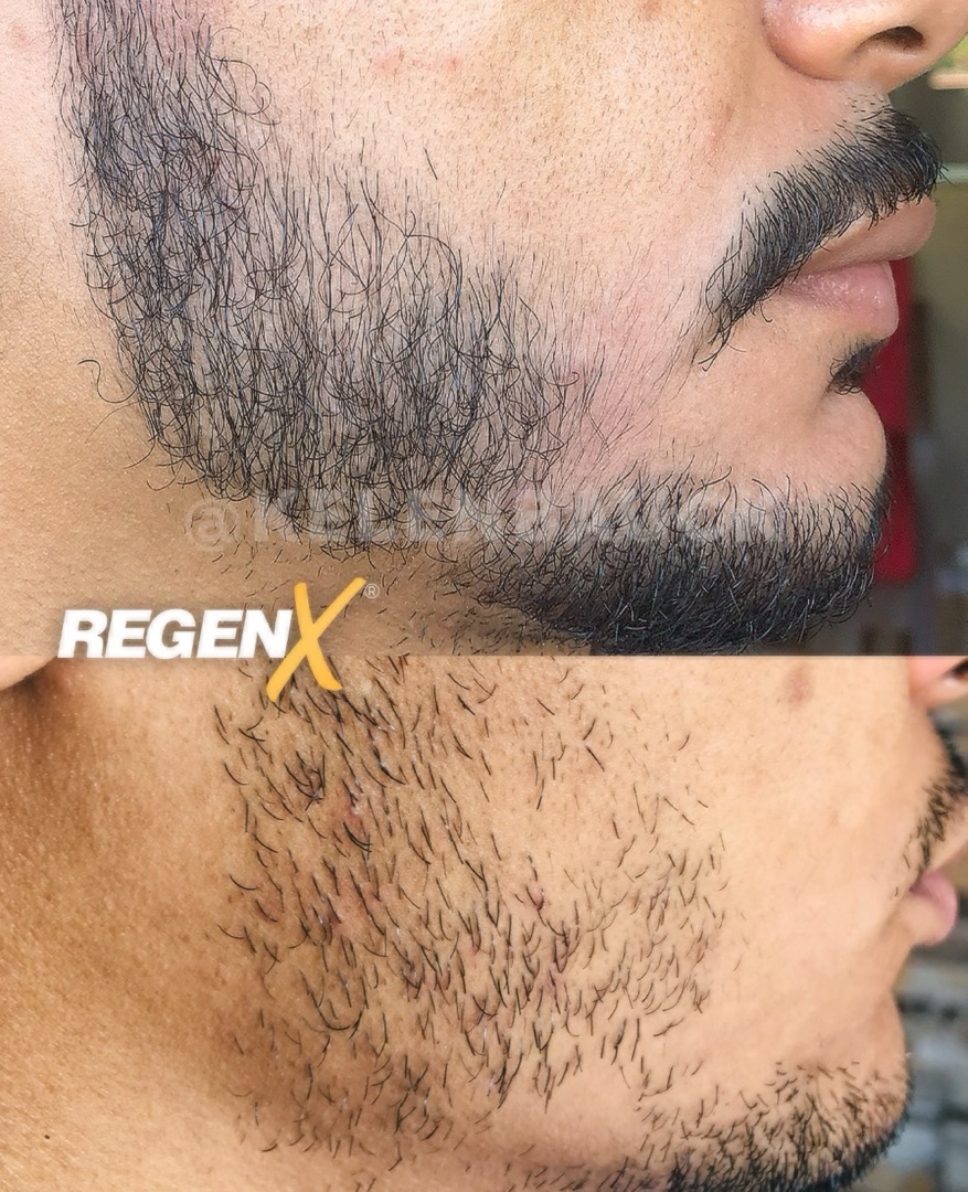 Regen X barbe