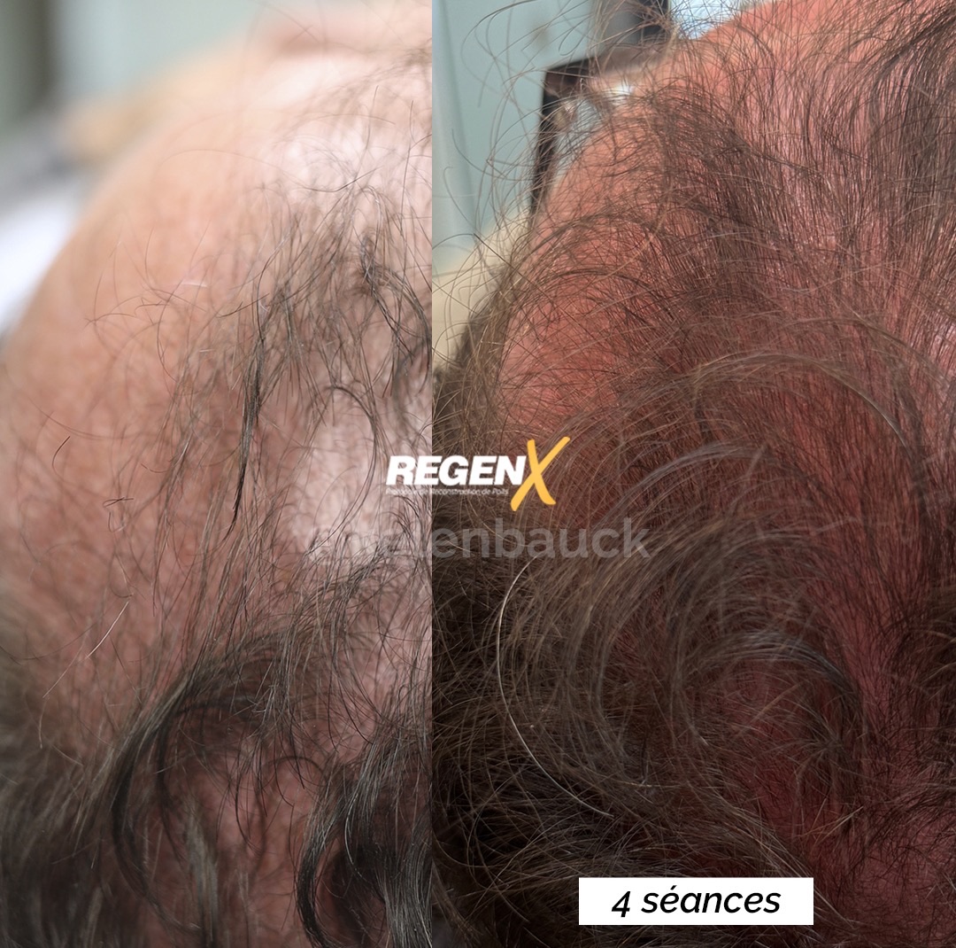 Regen X cheveux, 4 séances