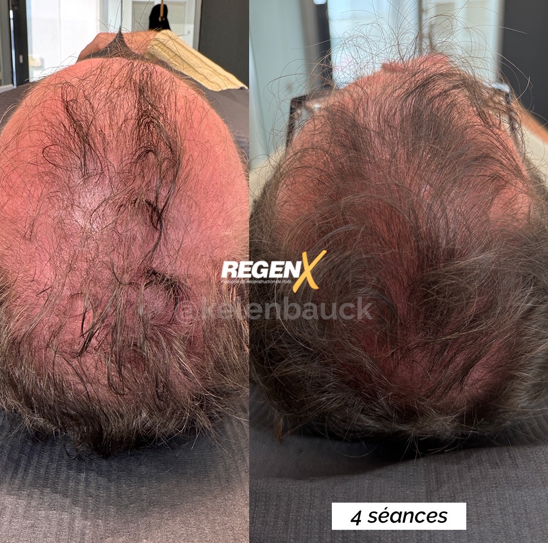 Regen X cheveux, 4 séances