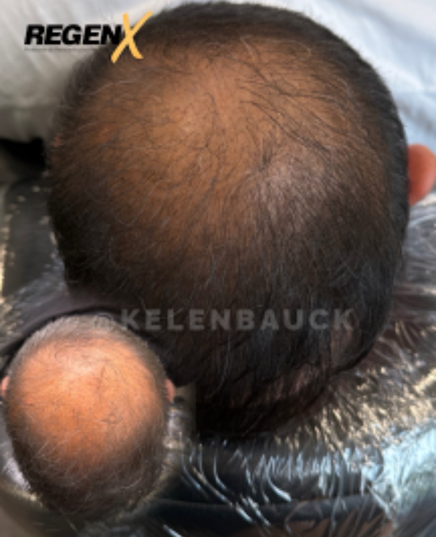 Regen X cheveux
