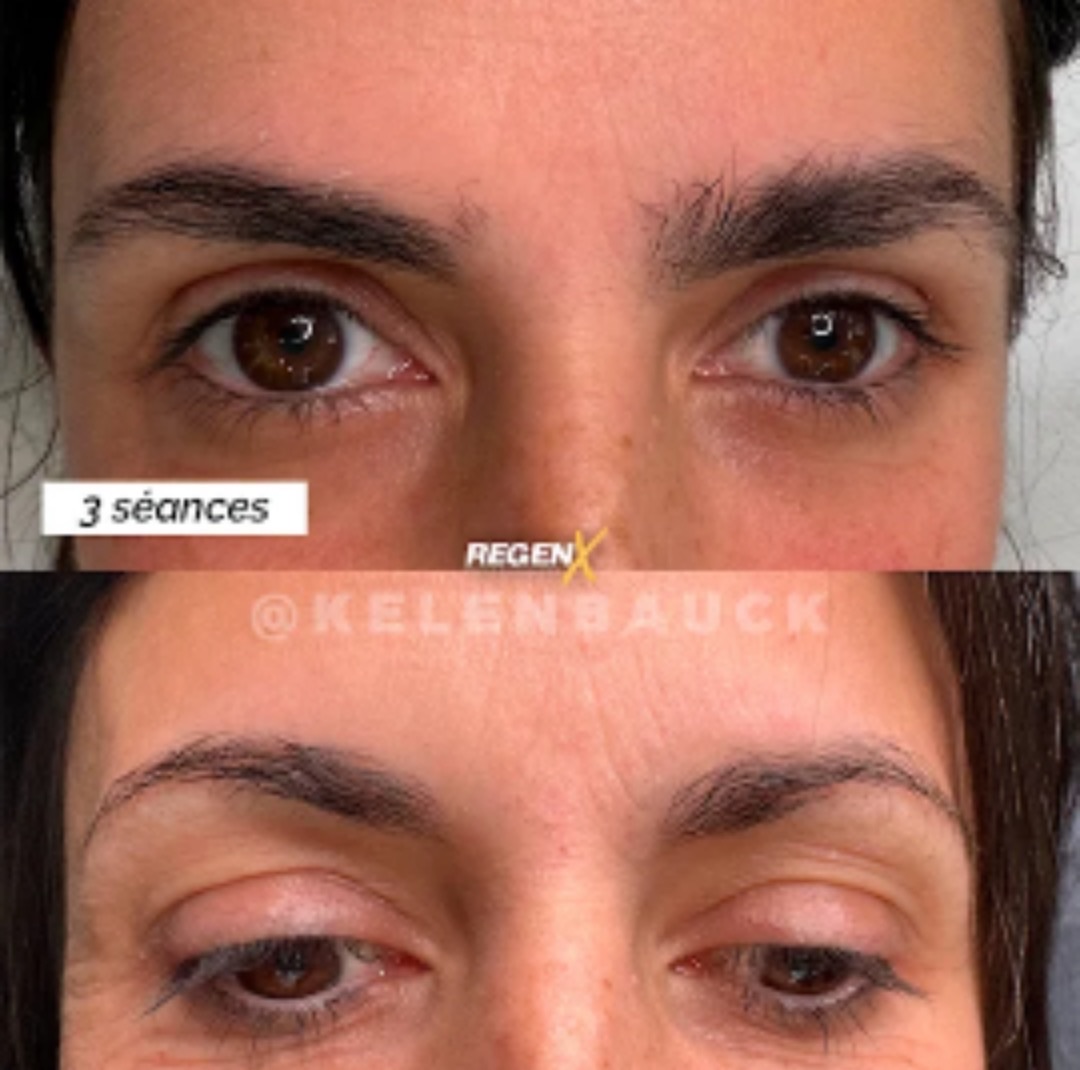 Regen X sourcils, 3 séances